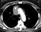 Contrast enhanced CT images at the level of the transverse aorta and left pulmonary artery show a lobulated mass in the right anterior mediastinum. The mass contains a coarse calcification and grows into the superior vena cava.  Note collateral circulation due to the obstruction of the superior vena cava. This is an example of Stage III disease.
